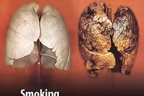 Gót chân Asin của bệnh ung thư