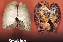 Gót chân Asin của bệnh ung thư