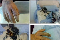 Bỏng da, bong võng mạc, vô sinh... vì điện thoại 