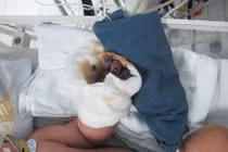 Bé sơ sinh bị hoại tử ngón tay có thể phải tháo khớp