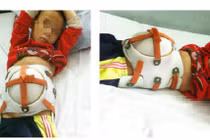 Phẫu thuật khối thoát vị khổng lồ cho bệnh nhi người Lào