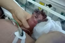 Cháu bé bị hoại tử tay nghi do tiêm phòng lao đã tử vong