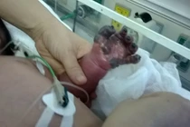 Cháu bé bị hoại tử tay nghi do tiêm phòng lao đã tử vong