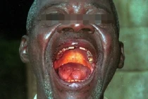 Ebola có thể vào Việt Nam qua con đường nào?