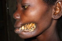 Hoại tử gương mặt do vi trùng tấn công