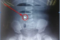 Cứu sống bệnh nhi bị tắc ruột do nuốt phải dị vật