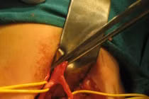 Phẫu thuật thành công ca dị tật hiếm gặp có một niệu quản