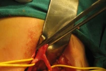 Phẫu thuật thành công ca dị tật hiếm gặp có một niệu quản