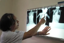 Cứu sống bệnh nhi bị "chết đuối trên cạn" 