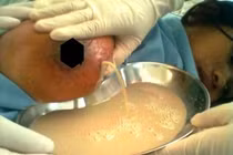 Kinh hãi lấy 500ml mủ từ vú sản phụ 17 tuổi
