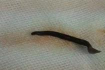 Nội soi gắp đỉa dài 4,5cm ra khỏi mũi bệnh nhân