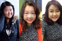 Ảnh 9X Việt cắt mí, làm mũi tại Hàn Quốc