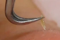 Video gắp mụn đầu đen dễ như trở bàn tay