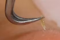 Video gắp mụn đầu đen dễ như trở bàn tay