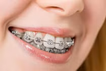 Hàm răng trước và sau khi niềng khác biệt thế nào?