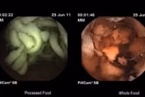 Video sợi mì tôm nguyên vẹn trong dạ dày sau 2 tiếng ăn