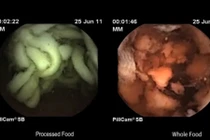 Video sợi mì tôm nguyên vẹn trong dạ dày sau 2 tiếng ăn