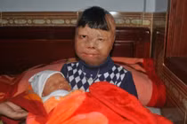 Bé trai bị bố tẩm xăng đốt mơ ước thành bác sĩ