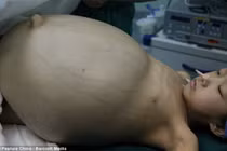 Đau tim xem ca mổ u quái Teratoma khổng lồ 15kg