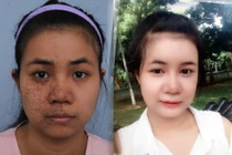 9X chàm đen nửa mặt đẹp ngỡ ngàng sau vài tháng sang Hàn Quốc