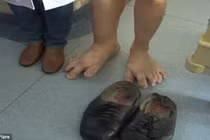 Chàng trai Trung Quốc có bàn chân khồng lồ dài 35cm