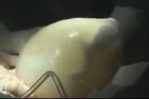 Cận cảnh ca sinh mổ bé còn nằm nguyên trong túi ối