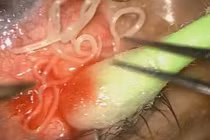 Rùng rợn cảnh gắp giun dài 20cm ký sinh trong mắt người