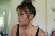 Nữ lễ tân nhà hàng bị tạt axit dã man