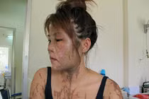 Nữ lễ tân nhà hàng bị tạt axit dã man