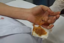 Truy sát trong bệnh viện, nữ điều dưỡng bị đâm thủng tay