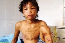 Vì đâu cậu bé Hào Anh sa ngã?