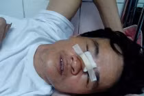 Dân tố bị công an bắn vào đầu: Trưởng CA huyện phủ nhận