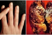 Nhìn 4 điểm phình to ở ngón tay biết ngay K phổi
