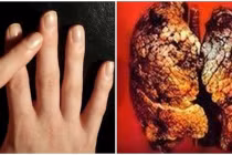 Nhìn 4 điểm phình to ở ngón tay biết ngay K phổi