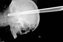 Sọ não bị chân ghế đâm xuyên 10cm, vẫn sống