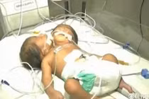 Bé trai hai đầu chào đời tại Ấn Độ