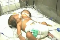 Bé trai hai đầu chào đời tại Ấn Độ