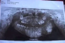 Kỳ lạ cậu bé mọc thừa 80 chiếc răng hàm 