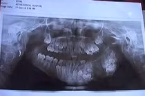 Kỳ lạ cậu bé mọc thừa 80 chiếc răng hàm 