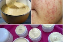 Mách bạn cách nhận biết kem trộn có chứa corticoid nguy hại da 