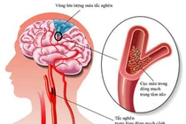 Nắng nóng 41 độ, hãy chú ý đến 7 dấu hiệu sớm của đột quỵ này để giúp bạn thoát chết 
