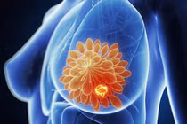 Cảnh báo 5 loại ung thư nguy hiểm có tính di truyền qua nhiều đời