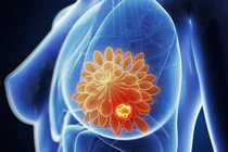 Cảnh báo 5 loại ung thư nguy hiểm có tính di truyền qua nhiều đời