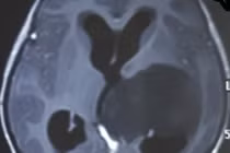 Chữa bệnh u não bằng chế độ ăn keto, bé 10 tuổi suýt mất mạng 