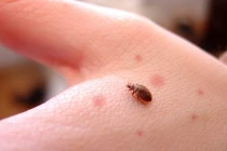 Bị rệp giường hút máu, làm ngay điều này để không tự giết mình