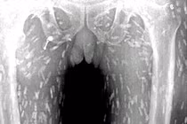 Khiếp đảm xem giun sán nhung nhúc khắp người vì ăn sushi