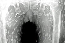 Khiếp đảm xem giun sán nhung nhúc khắp người vì ăn sushi