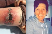 Rùng mình những tai họa hình xăm gây ra cho sức khỏe