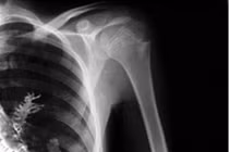 Kinh dị những trường hợp cây mọc trong cơ thể người