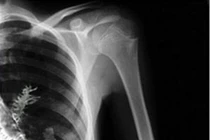 Kinh dị những trường hợp cây mọc trong cơ thể người